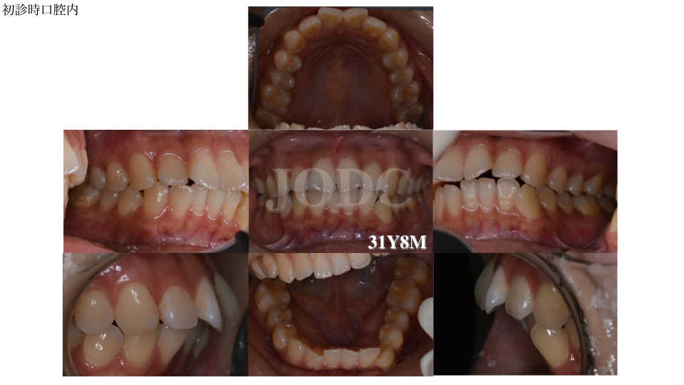 ハーフリンガル30代女性a様矯正日記 甲府市の矯正歯科 純矯正歯科クリニック