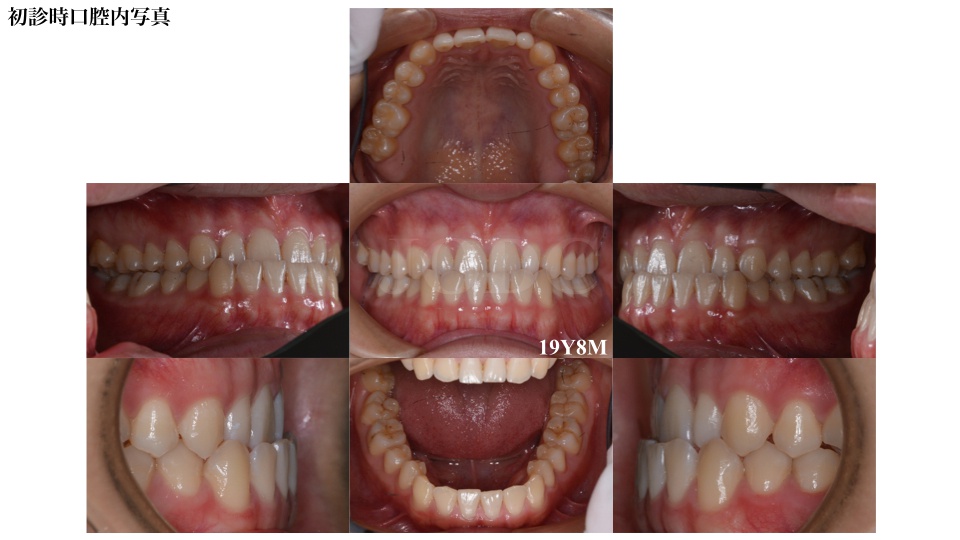 ハーフリンガルブラケット矯正装置 セルフライゲーションリンガル セルフライゲーションラビアル 10代男性f様矯正症例 甲府市の矯正歯科 純矯正歯科クリニック